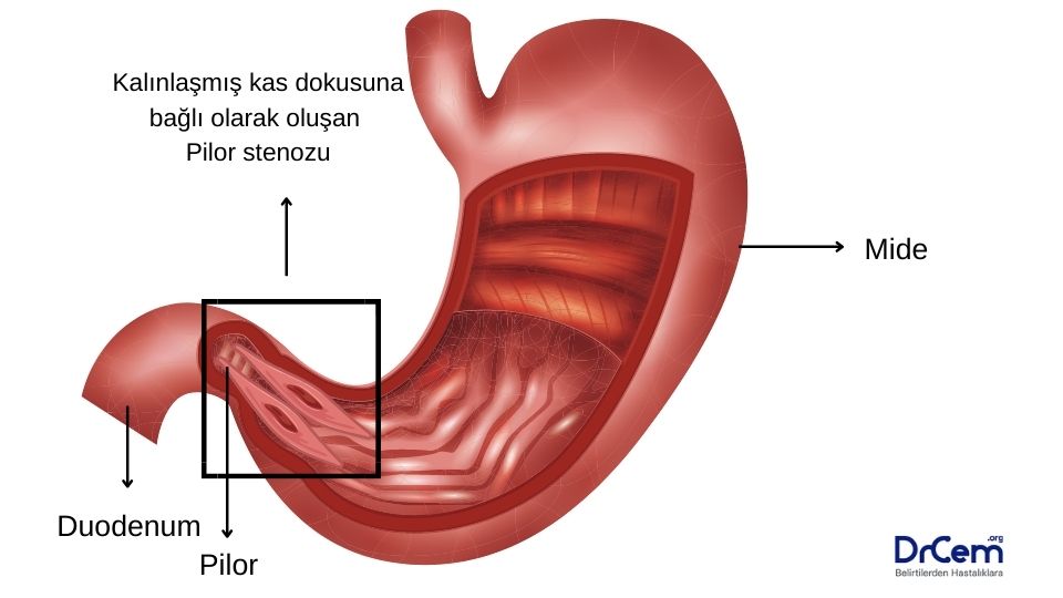 Pilor Stenoz görseli - DrCem hastalık rehberi